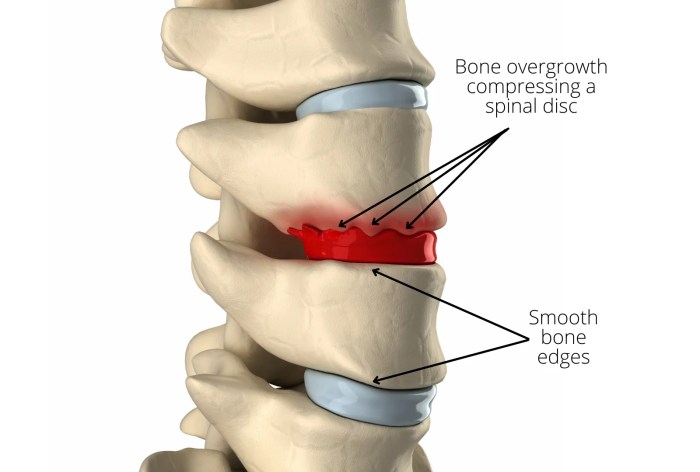 Neck cervical arthritis bone spur spine ray degeneration osteophytes lower can symptoms rays like chiropractic whiplash osteoarthritis osteophyte degenerative spinal