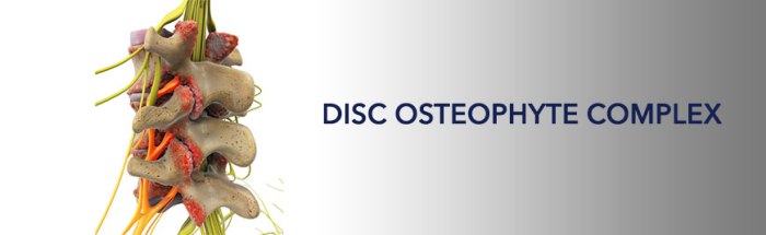 Disc osteophyte complex bonati slipped permalink treatment