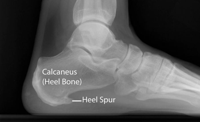 Osteophytes lipping cervical spine kindle