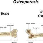 Osteofit: Penyebab, Gejala, Dan Pengobatannya