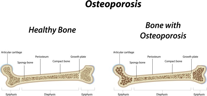 Osteofit: Penyebab, Gejala, Dan Pengobatannya